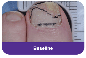 Diabetes toe at baseline